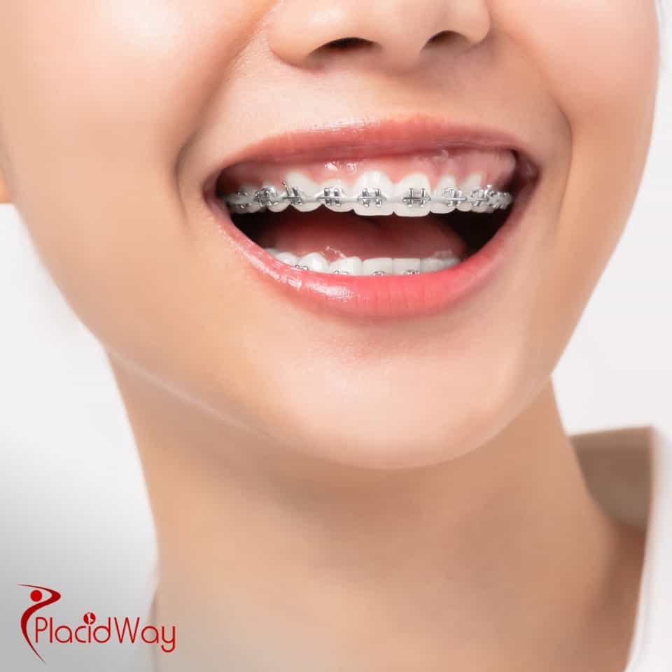 ¿Cuál es el costo de los brackets en México comparado con Estados Unidos?