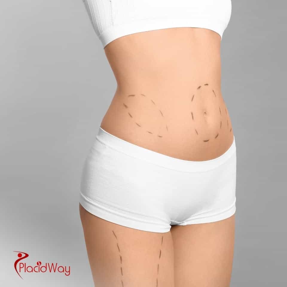 ¿Qué país ofrece los procedimientos de liposucción más asequibles?
