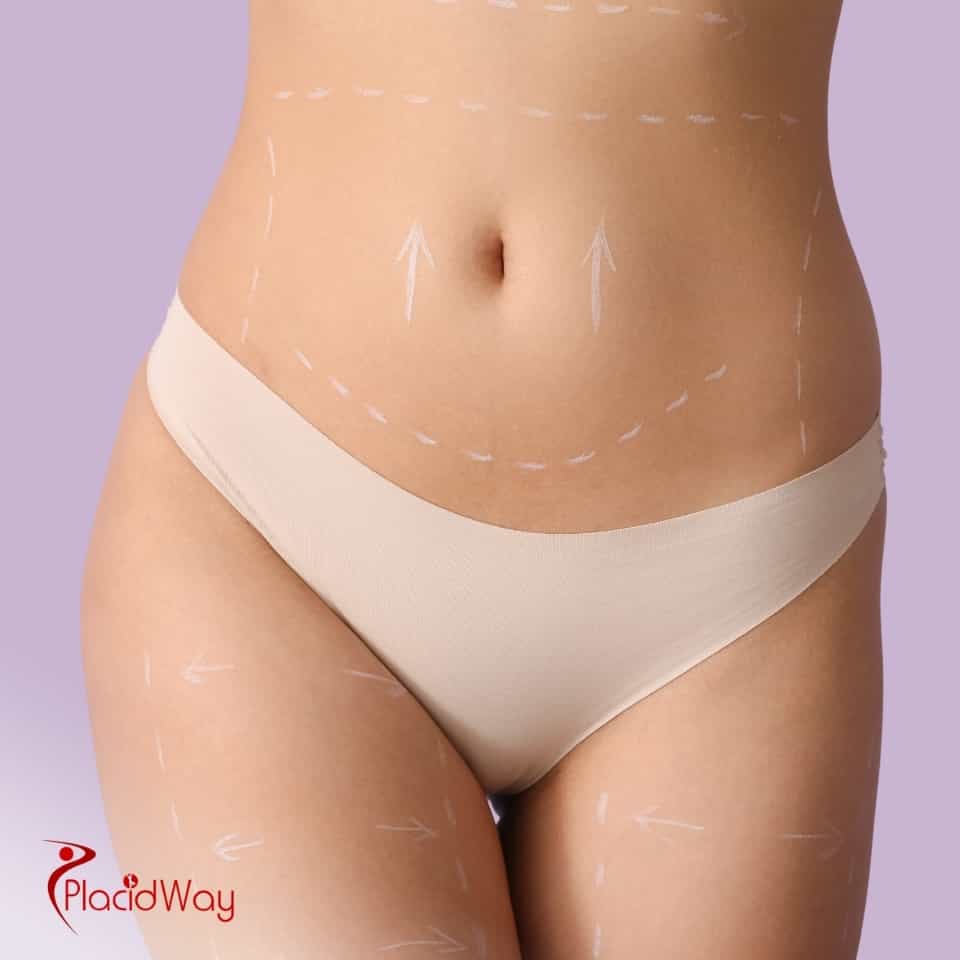 ¿Cuánto cuesta la abdominoplastia en México?