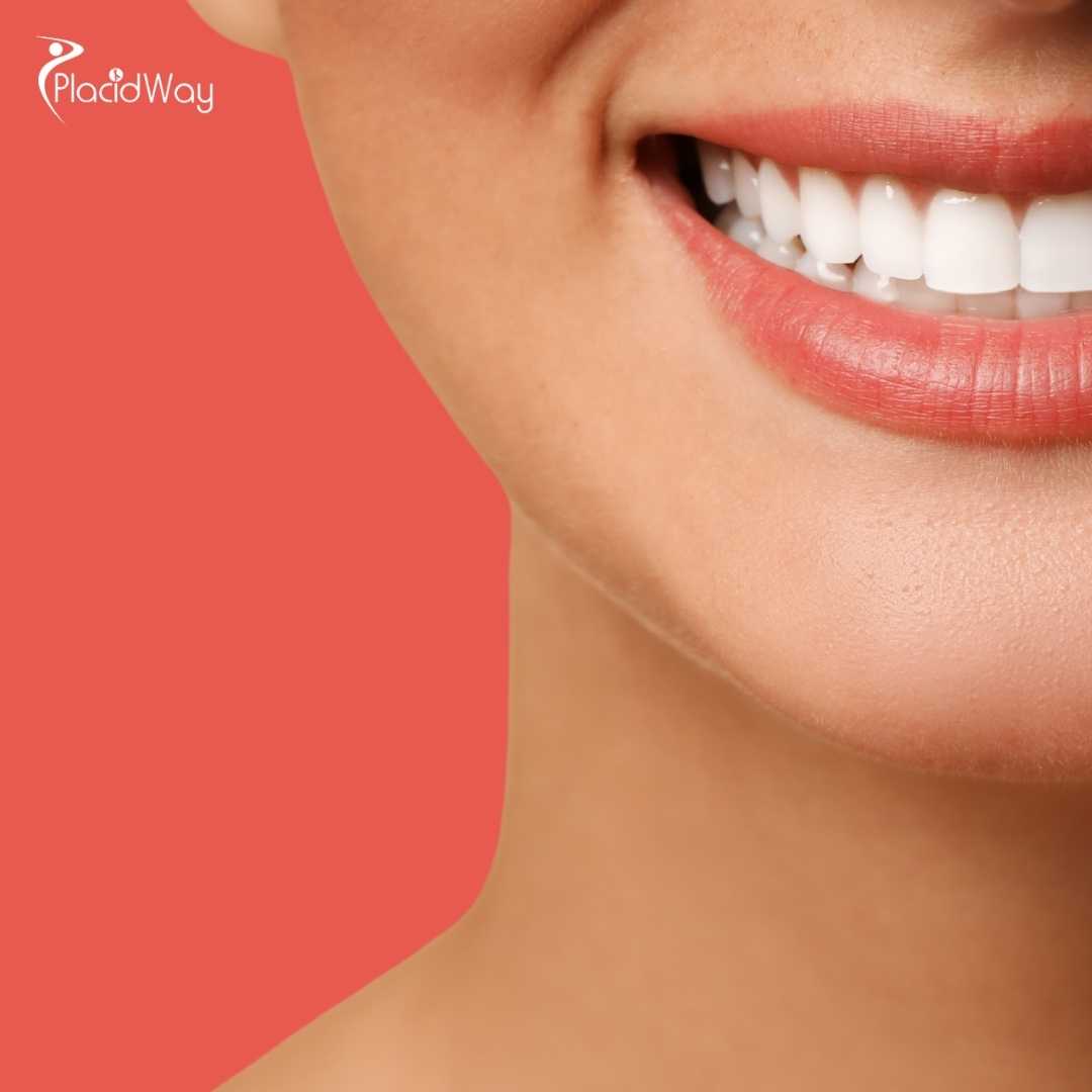 ¿Valen la pena las carillas dentales en México?