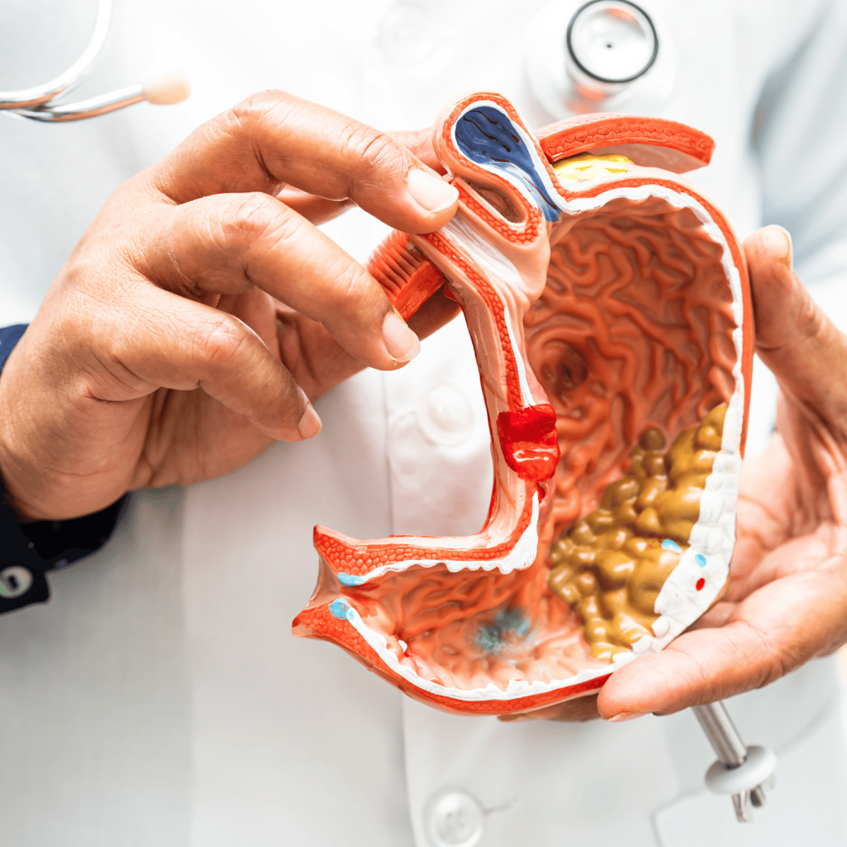 Tratamiento del cáncer de colon en etapa 4 en México