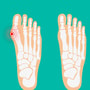 TURAN&TURAN Health Group, cirugía de hallux valgus/juanete con tecnología 3D LAPIDUS en Bursa/Estambul, Turquía thumbnail