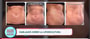 Miniabdominoplastia con el Dr. Ary Papadopulos - Cirugía Plástica en la Ciudad de México, México thumbnail