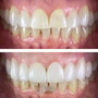Paquete de empastes y uniones dentales en Nuevo Progreso, México thumbnail