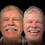 Implantes dentales asequibles de Dental Artistry y World Dental Center en Nuevo Progreso, México thumbnail