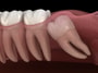 Paquete de extracción de muelas del juicio en Nuevo Progreso, México por Dental Artistry y World Dental Center thumbnail