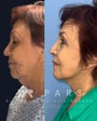 Paquete de lifting facial profundo en Guadalajara, México, con PARS thumbnail