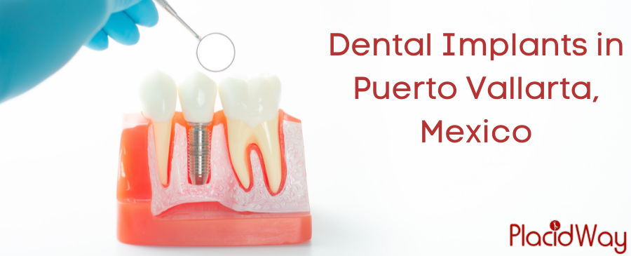 Implantes Dentales en Puerto Vallarta, México - Bajo Costo y Calidad