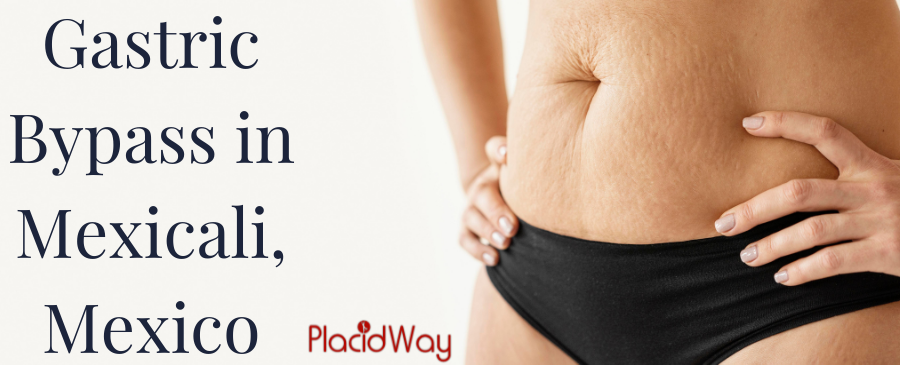 Bypass Gástrico en Mexicali, México