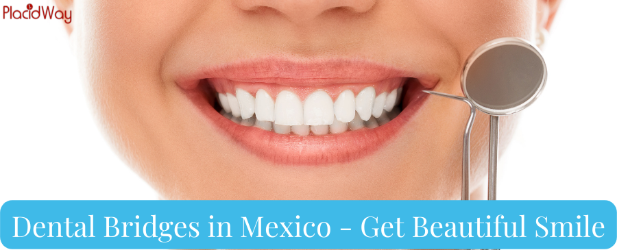 Puentes dentales en México - Obtenga una sonrisa hermosa
