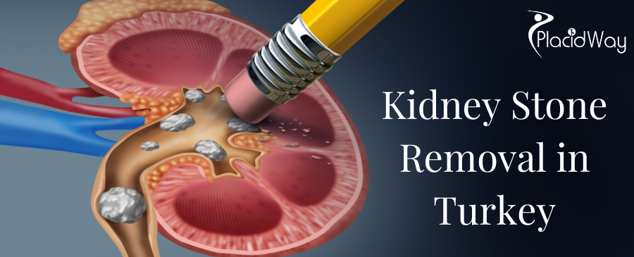 Cirugía de extracción de cálculos renales en Turquía