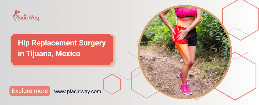 Reemplazo de Cadera en Tijuana - Mejore la Salud de su Cadera