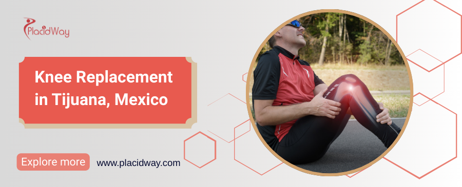 Reemplazo de Rodilla en Tijuana - Recupere la Salud de sus Rodillas
