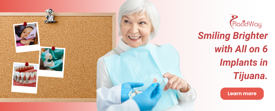 Implantes dentales All on 6 en Tijuana, México