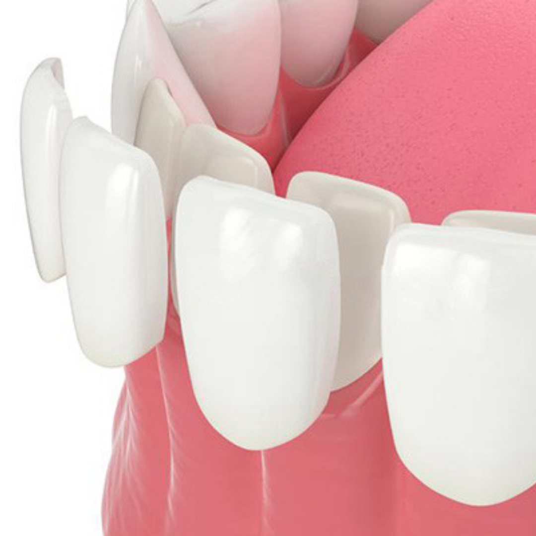 Carillas en Los Algodones, México por Sani Dental Group